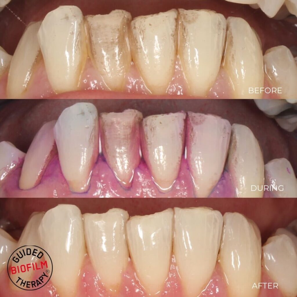 teeth being treated with  airflow polishing