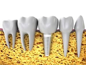 bone graft Liverpool implants