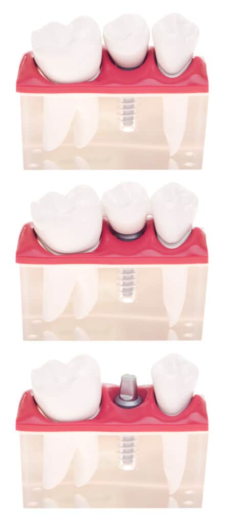 Dental Implant Step By Step Liverpool
