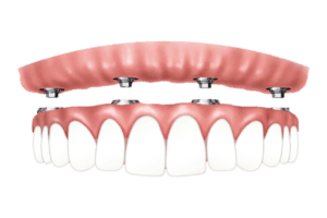 implant retained dentures Liverpool