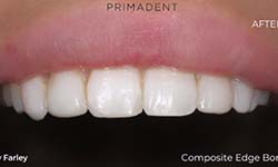 image of teeth after composite bonding