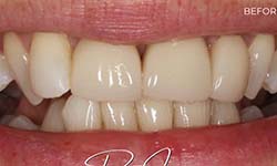 an image of teeth before cosmetic dental porcelain veneers