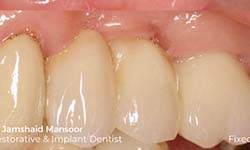 image of teeth after getting dental bridge