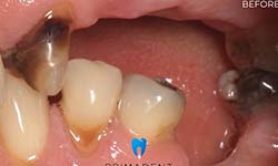 patient teeth before getting dental bridge