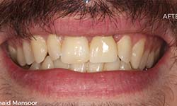 after image of patient teeth who got dental implants