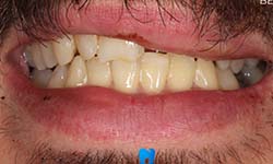 image of teeth before getting dental implants