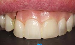 image of teeth after getting dentures