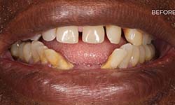 an image of a man's teeth before getting full arch dental implants
