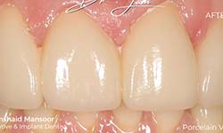 image of teeth after getting porcelain veneers