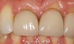 picture of teeth after getting porcelain veneers
