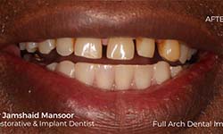 image of a man's teeth after getting full arch dental implants