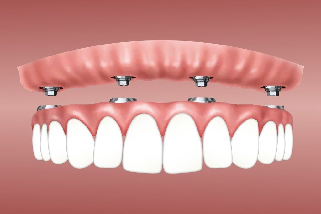 all on 4 dental implant