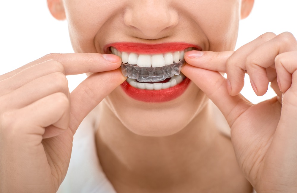 Invisalign Liverpool