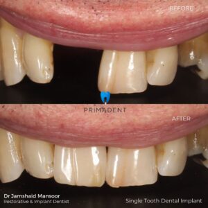 single tooth implant case 2