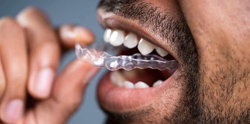 Dos and don'ts of Invisalign