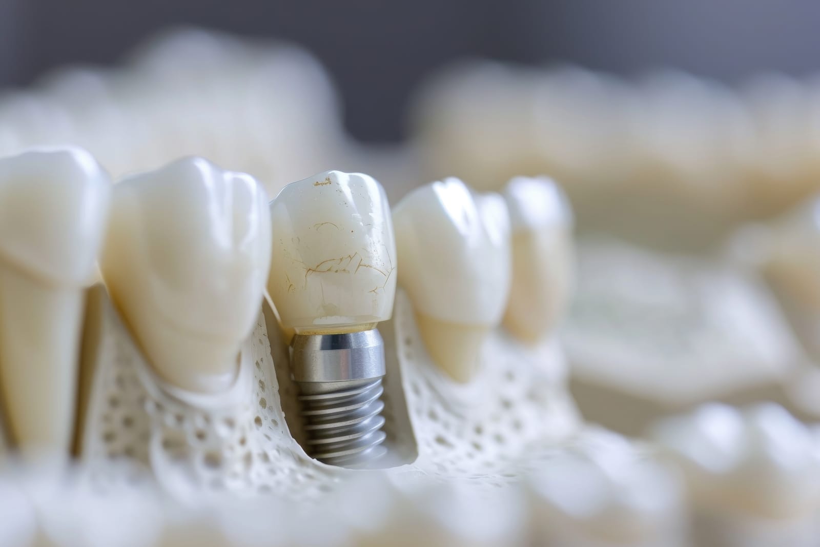 Dental implants in Liverpool